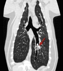 Coronal CT scan of the chest showing both lungs. A red arrow points to an abnormal area in the lower region of the right lung, suggesting a possible lesion or mass, similar to how Pet paw and nail care Australia highlights potential issues in pet health.